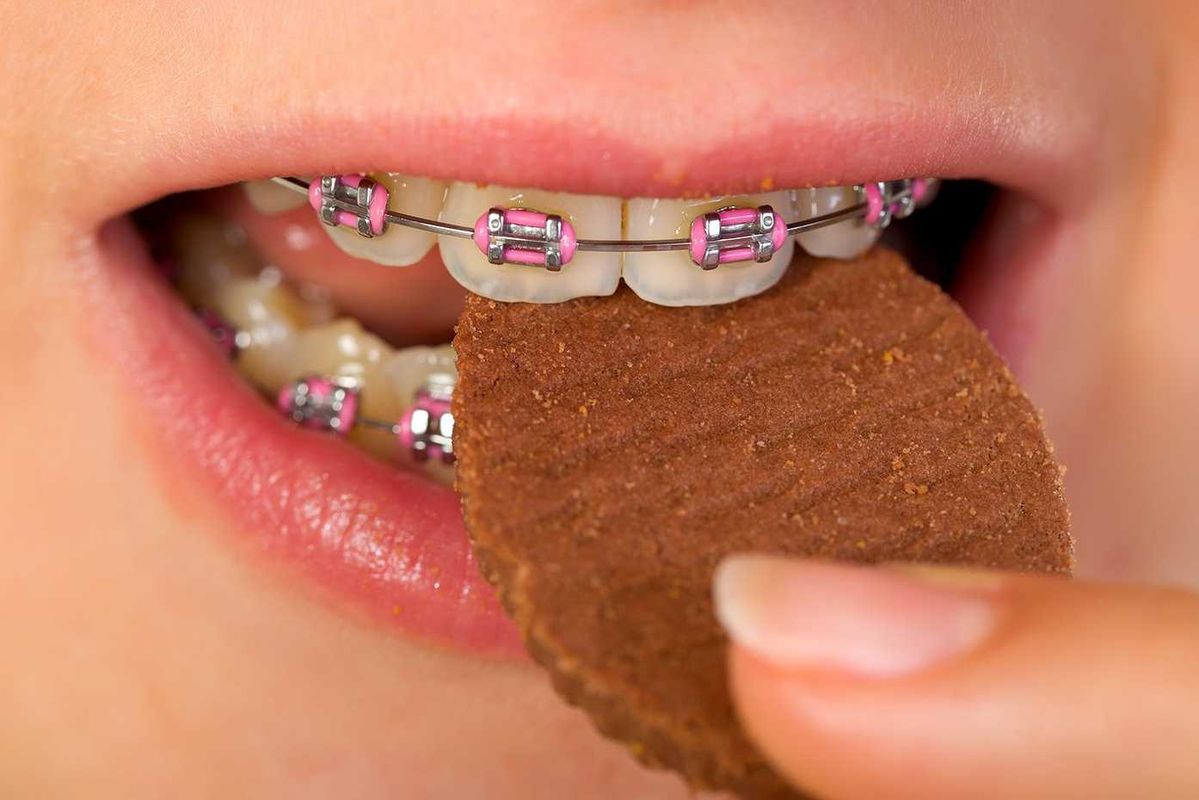 niềng răng ăn gì tốt